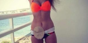 woman with wrapped colostomy pouch